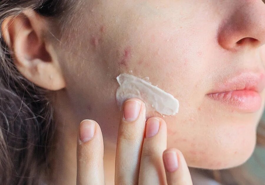 Nặn mụn xong skincare như thế nào và chăm sóc da sau khi nặn mụn